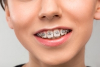 Co warto wiedzieÄ‡ przed zaÅ‚oÅ¼eniem aparatu ortodontycznego?