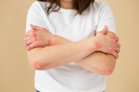 Metody zarządzania stresem przy atopowym zapaleniu skóry